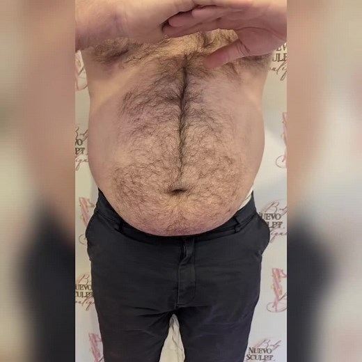 Before and after one session of flanks and stomach fat dissolving using Lemon Bottle 🍋 for this lovely Gent! Absolutely loving his results so far excited to see after his second session!For more information or to book your appointment please dm @nuevosculpt on Instagram Get yourself Summer ready!☀️🏖️◽◽◽◽◽◽◽◽◽◽◽◽◽◽To book or for more information please dm noninvasivebbl #bodycontouringuk #noninvasivelipouk #laserlipouk #cincelar #laserlipobrighton #cavitationuk #cavitationlondon #nes #londonbod