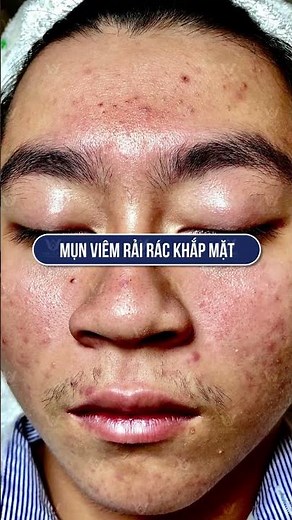 The Acne Treatment Secret: HHV Clinic & Hien Van Spa Revealed