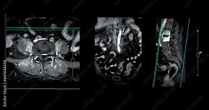 MRI L-S spine or lumbar spine showing spinal tuberculosis. Stock Video