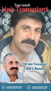 3.1K reactions · 55 shares | "✨ 100% FUE Hair Transplant Success! ✨ Afzal from Arbab Road, Peshawar, achieved a full, natural look with our advanced hair restoration technique. ‍♂️ Transform your confidence today—schedule your consultation now!  #FUEHairTransplant #Peshawar #HairRestoration" | HAIR restore Transplant center | Facebook