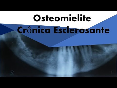 Osteomielite Crônica Esclerosante | Odontologia | Dra Bianca Rosa