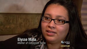 Conjoined Twins Undergo Complicated Separation Surgery