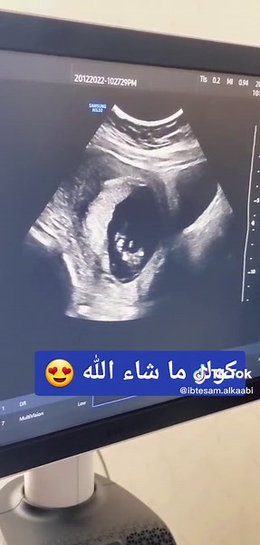 Ultrasound Images of a Developing Fetus