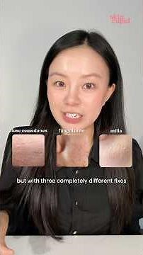 Closed comedones vs fungal acne vs milia 🌟 + how to treat them