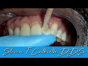 Direct Temporary Veneer - Dental Minute with Steven T. Cutbirth, DDS