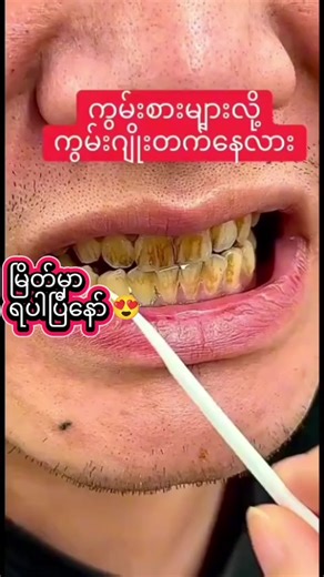 မြိတ်မှာ သွားဖြူဆေး ဝယ်ယူနိုင်ပြီ!