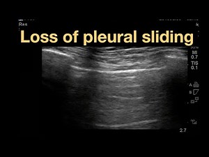 E-FAST & Lung Ultrasound