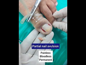 Partial Nail avulsion of both sides Grace Clinic Dehradun # thanks Ansh | Ingrown toenail surgery