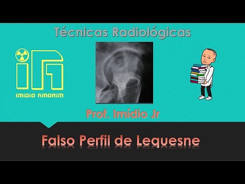 Radiografia do Quadril - método de Lequesne - Falso Perfil