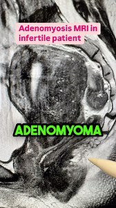 WANT ME TO LOOK AT YOUR MRI ? LINK IN PROFILE ! What does adenomyosis look like? Here’s a good example where you could very much see everything. So this is the uterus. This is the bladder. This white area here is the lining of the uterus and this area here is a posterior adenomyoma. You could see that the you see the dotted these little dots those are little islands of adenomyosis and some changes which are mostly fibrotic inside the muscle and this can be also seen very clearly on ultrasound an