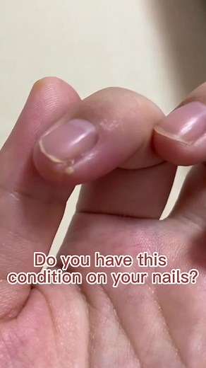 Anti Paronychia Relief Oil: Repair Damaged Discolored Thick Nails