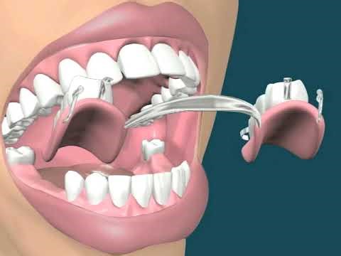 Dental Video of RPD Lower Posterior - The Tooth
