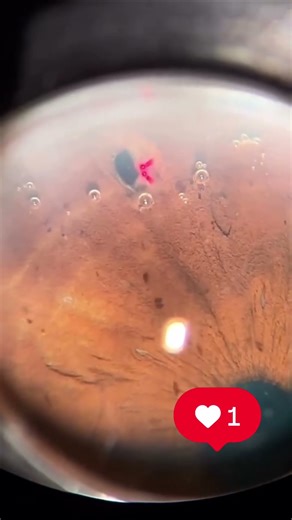 Watch a YAG Laser Iridotomy Save an Eye 👁️ | Real Glaucoma Treatment