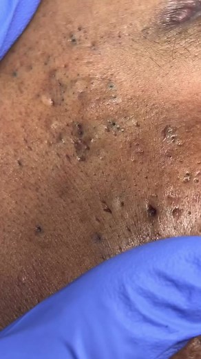 Level 2 Deep Cleansing Facial for a First Timer by your Fave 🐐 • • • #thealluringesthetics #deepcleansing #skincare #houstonesthetician #extractions #acne #blackheadremoval #firsttimefacial #dermaplaning #extractioncam #deepporecleasning