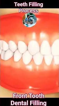 Tooth Filling Procedure Animation Teeth Filling Process # Medical healthcare