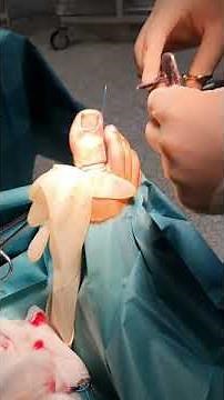 chirurgie de l'ongle incarné