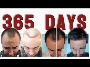 I took a picture every day after my Hair Transplant last year, I compiled the footage in a time lapse video. If someone wishes to see how my transplanted hair grew in a year. Here's my head :)