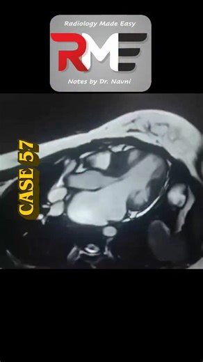 Radiology Made Easy Notes by Dr Navni Garg on Instagram: "Case 57: Severe SAM in HOCM — CMR Spotlight 💥❤️ Contributed by Dr. Shubhi Agarwal Here’s a classic cardiac MRI finding every resident must recognise! Key features to observe: 🔸 Severe SAM of anterior mitral leaflet 🔸 Narrowed LVOT during systole 🔸 Septal hypertrophy 🔸 Posteriorly directed MR jet In Hypertrophic Obstructive Cardiomyopathy (HOCM), the thickened septum + Venturi effect pulls the anterior mitral leaflet towards the LVOT 