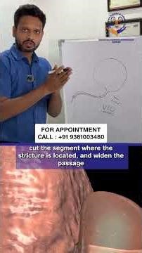 Surprising Urethral Stricture TREATMENT That Works FAST