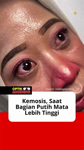 Kemosis, Saat Bagian Putih Mata Lebih Tinggi