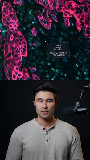 Microsoft's AI can now detect cancer from a $10 tissue sample.For context, every time tumor cells are tested, doctors create a basic microscope slide to study tissue up close.These slides show cell shapes and structures, but they can't reveal which immune cells are actually fighting the cancer.That deeper picture is critical for knowing if a patient will respond to immunotherapy... But the advanced imaging needed costs THOUSANDS.So Microsoft built GigaTIME -- an AI system that generates advanced