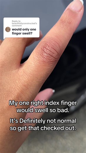 Understanding Finger Swelling: Causes and Treatment