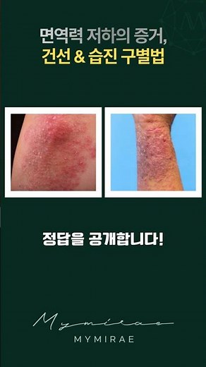 면역력 비상 건선? 습진?구별법!