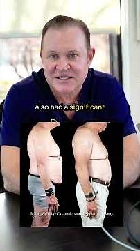 Male Tummy Tuck | 360 Belt Lipectomy