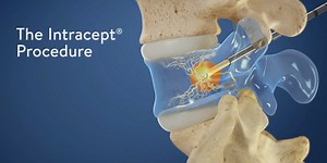 Swift Institute helping turn off lower back pain with Intracept Procedure