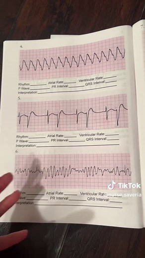 Understanding Bigeminy: A Unique Cardiac Rhythm
