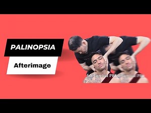 Palinopsia Treatment, Afterimage, Trailing image HELPED by Dr Suh