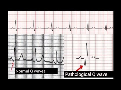 Pathological Q waves in ECG || How to identify pathological Q waves in E CG
