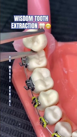 WISDOM TOOTH EXTRACTION 🦷🥴