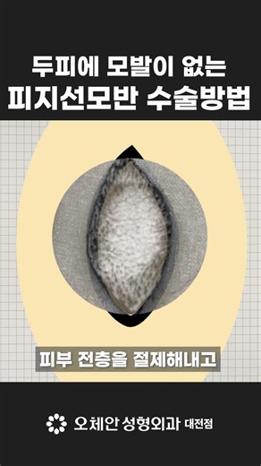 두피 피지선모반, 이렇게 간단하게 제거돼? #수술 #소아피부질환