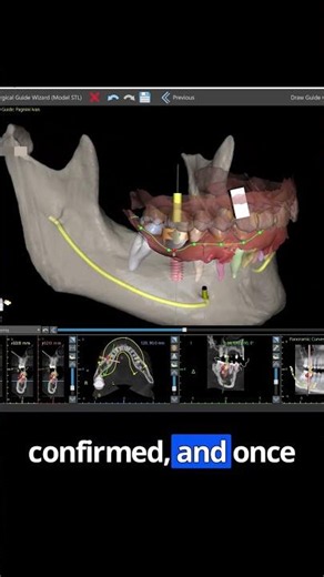 FULLY AUTOMATIC IMPLANT PLACEMENT AND SURGICAL GUIDE DESIGN! #digitaldentistry #dentalimplants