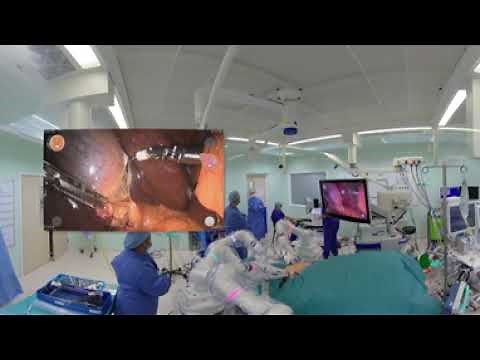 Versius 360 Robotic Cholecystectomy at Manchester Royal Infirmary