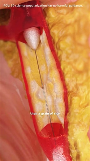 How Rotational Atherectomy Is Done? #rotationalatherectomy #atherectomy