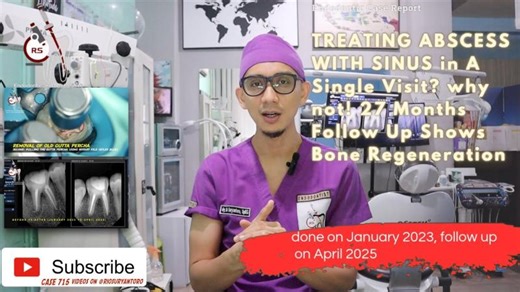 ONE VISIT ROOT CANAL TREATMENT 1st MOLAR, 27 MONTHS CONTROL, PUS   ABSCESS   RADIOLUCENT :HEALING 🦷