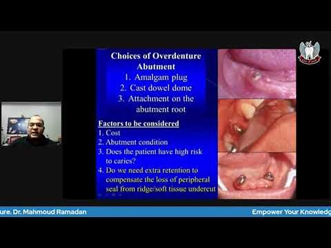 Tooth Supported Overdenture Part 3: Treatment planning and clinical procedures