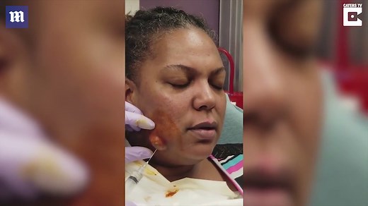 Woman has massive abscess erupt from her face
