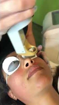 Laser Genesis Lip Treatment - Cutera Excel-HR