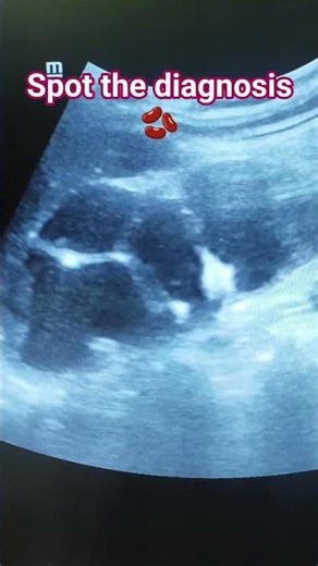 Case 4#shorts #ytshorts #radiology #radiologylife #scan #ultrasound #kidney #mbbs #md #medico