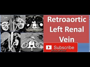 Retroaortic Left Renal Vein