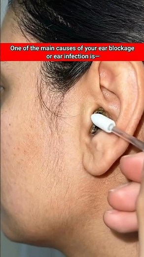 S.303||Avoid Using Q-tips/Ear Buds!!#shorts,#shortvideo,#healthtips,#emergency,#drmohofilmondal..