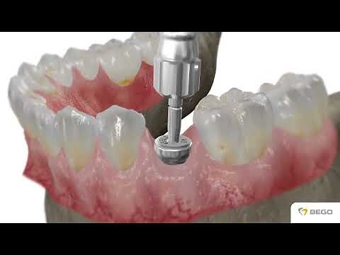 BEGO Semados® SC SCX Implantate implants