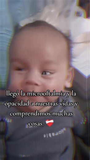 llegó la microoftalmia y la opacidad corneal a nuestras vidas, y así pudimos entender y comprender que existen dos sonrisas en la vida la social que aprendemos por qué vemos a otras personas sonriendo (expresión que no se enseña una persona sin visión) y la sonrisa que tenemos cuando algo o alguien nos hace feliz, eso quiere decir que cada que mi hijo sonríe lo hace porque me habla con el corazón y es o esta felíz. ♥️ #microftalmia #opacidadcorneal #esquinzencefalia #hidropsfetal #viral