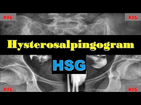 Hysterosalpingogram | HSG