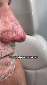A wound on the nose that won't heal... it might not just be a wound #dermatologist