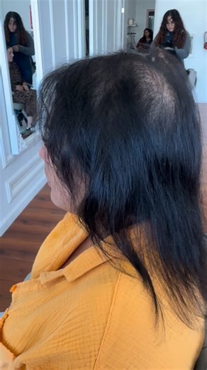 Ktip and Topper Combination #ktips #hairextensions #russianhair #microktips #coldfusion #humanhair #hairline #vlighthairextensions #humanhair #shorthair #russianhair #humanhair #hairtopper #hairloss | Regal cosmetic