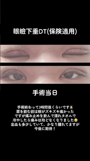 眼瞼下垂手術(保険適用) 手術当日 #眼瞼下垂 #眼瞼下垂DT #二重整形 #二重全切開 #保険適用